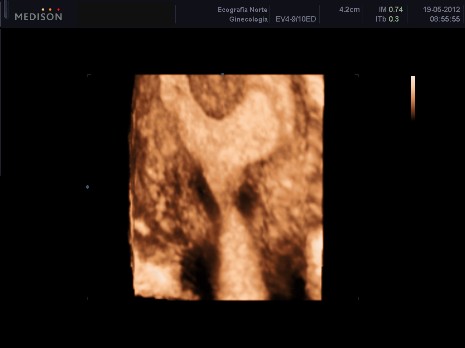 Reconstrucción tridimensional de útero septado (bicorne)