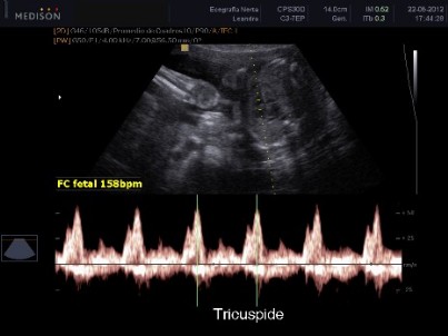 Doppler tricuspídeo