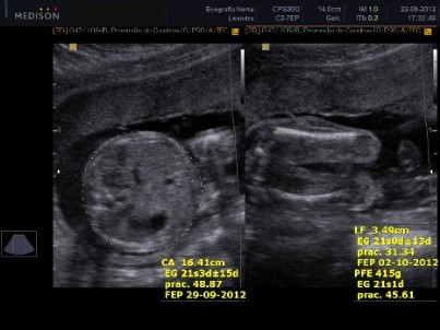 Corte transverso del abdomen / Longitud femoral