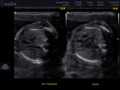 Arteria Pulmonar / Arteria Aorta