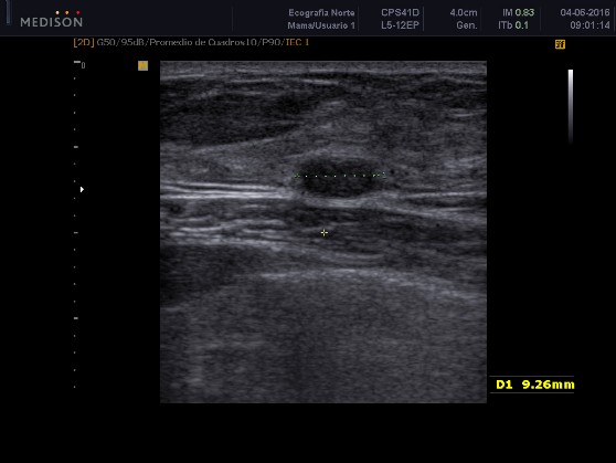 Imagen nodular compatible con Fibroadenoma