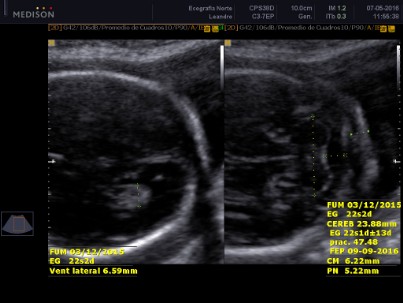 Fosa Posterior