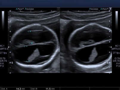 Corte Transverso de craneo fetal demostrando ventriculomegalia
