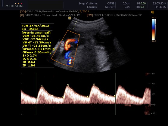 Doppler de la Arteria Umbilical