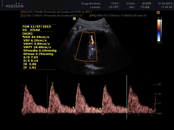 Doppler de la Arteria Cerebral Media