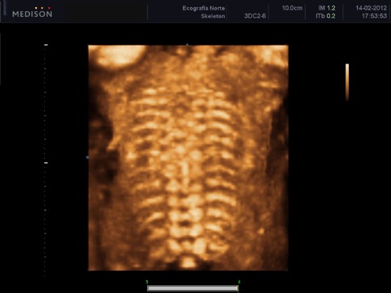 Renderización 4D de la columna fetal